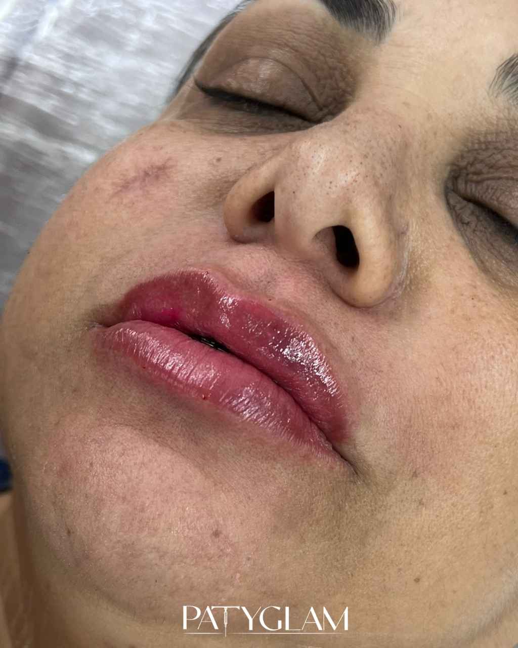 Depois - resultado do procedimento